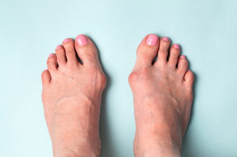 Do Bunion Correctors Work Northwest Surgery Center