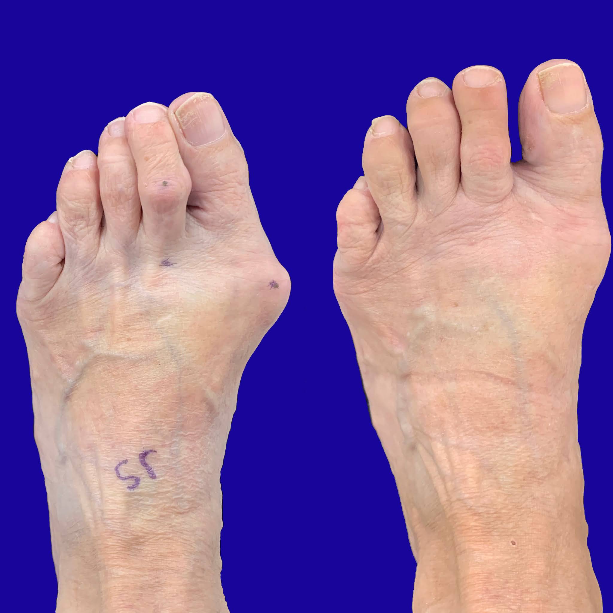 Before and After Bunion Surgery Photos Northwest Surgery Center