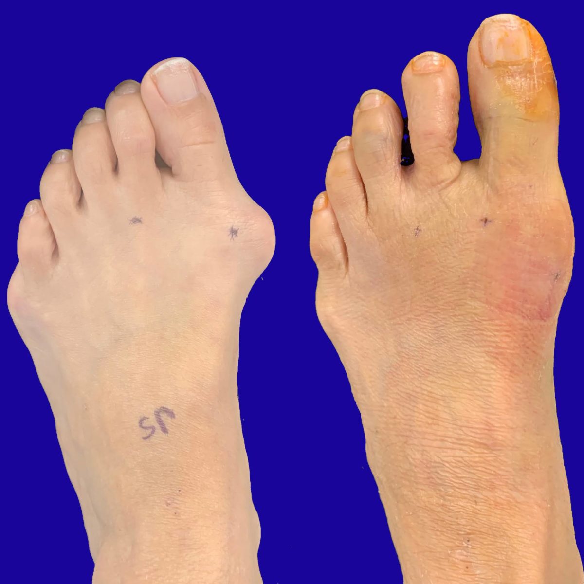 Before And After Bunion Surgery Photos | Northwest Surgery Center