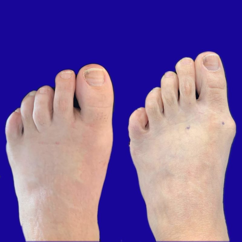 Before and After Bunion Surgery Photos | Northwest Surgery Center