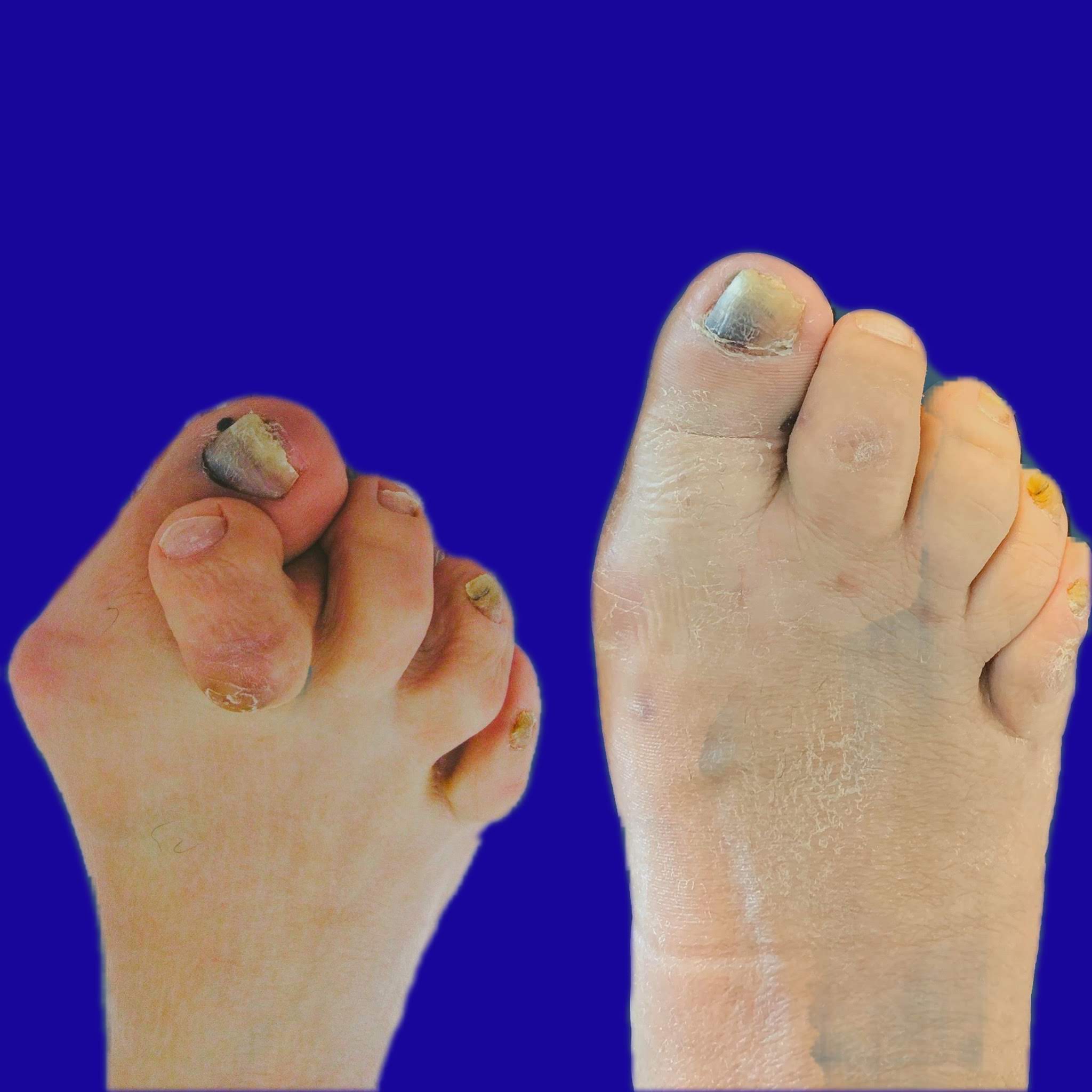 Before And After Bunion Surgery Photos The Bunion Cure