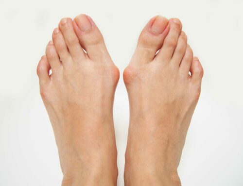 Bunion Symptoms: How to Know It’s Time to See a Specialist