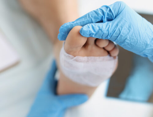 What is the Bunion Surgery Success Rate?