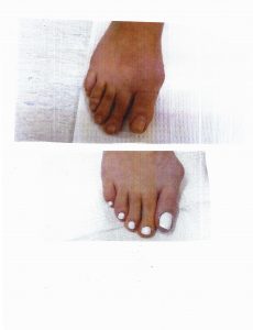 Before-and-After-Bunion-Surgery-2