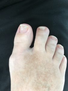Before and After Photo - After Surgery Photo