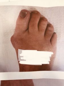 before bunion surgery