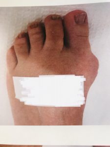 before bunion surgery with bandages