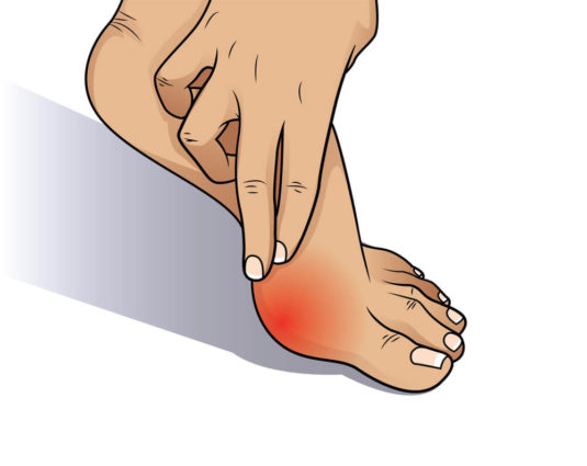 a red swollen area to learn how to treat bunion pain
