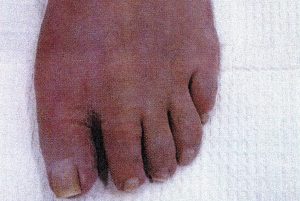 Bunion Removal Surgery After