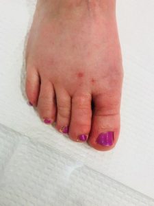 Bunion surgery removal after photo