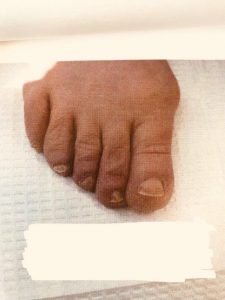 Bunion Surgery Removal Before Photo