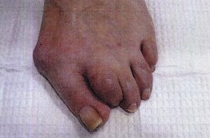 Bunion-removal-before-1