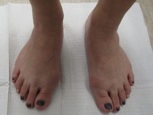 Bunion-removal-before-1