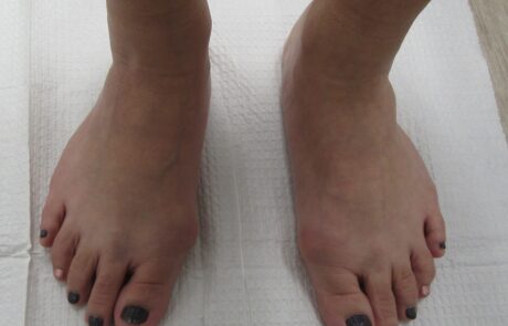 bunion surgery