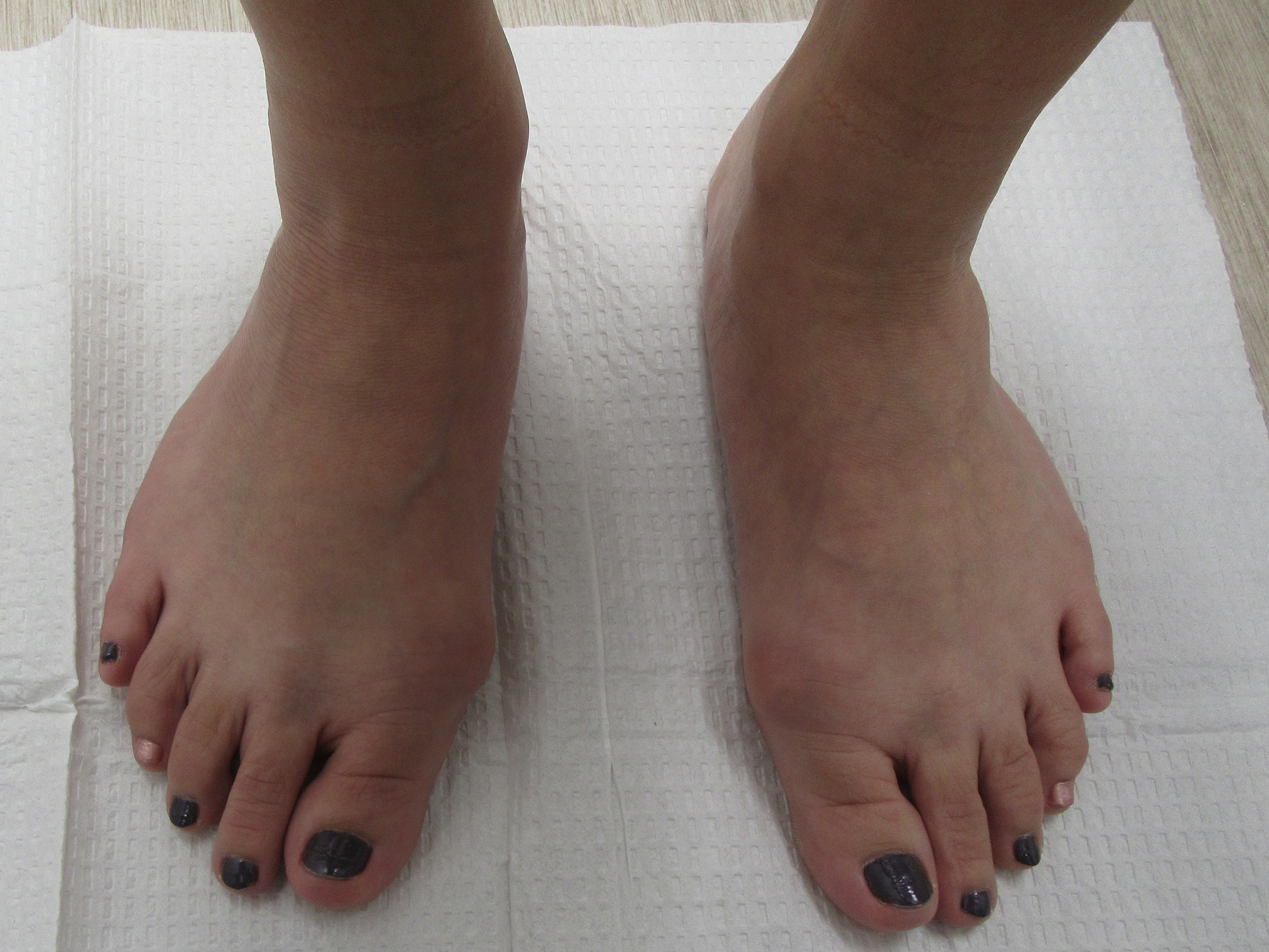 Bunions before surgery.1
