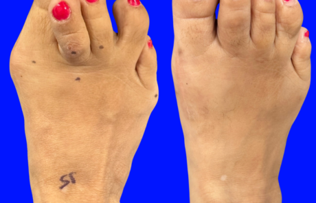 before and after bunion