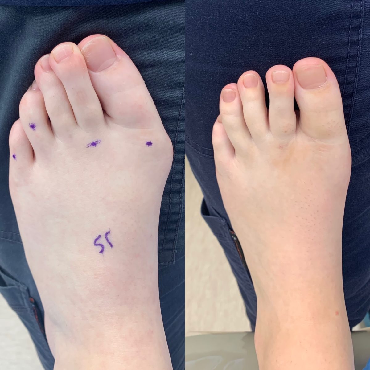 Before and After Bunion Surgery Photos | Northwest Surgery Center