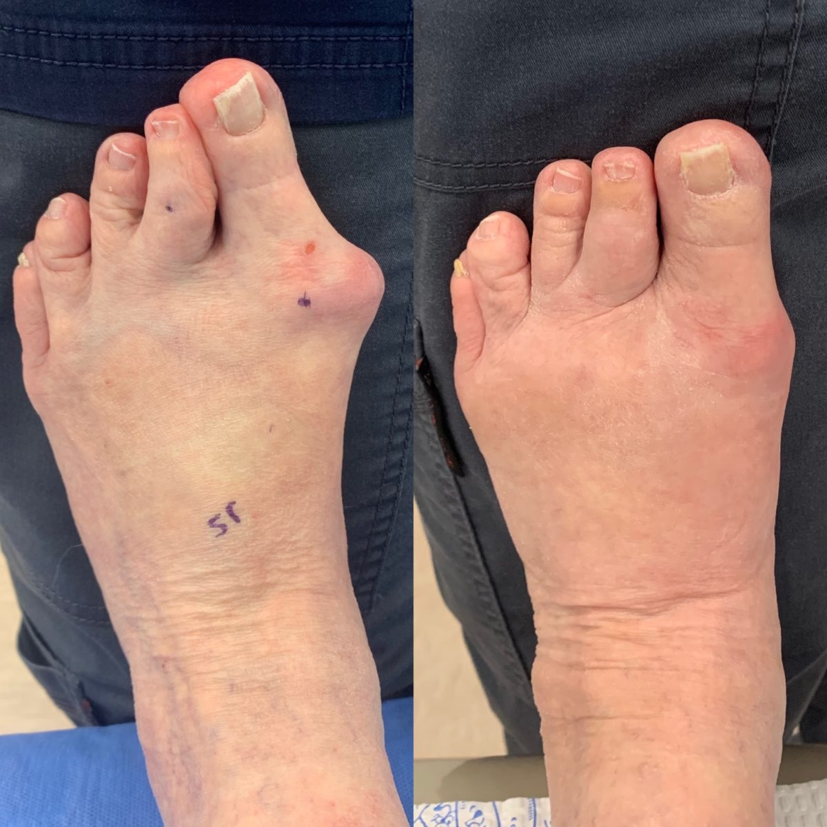 Before and After Bunion Surgery Photos Northwest Surgery Center