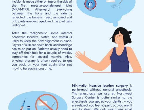 Infographic – Minimally Invasive Bunion Removal Surgery