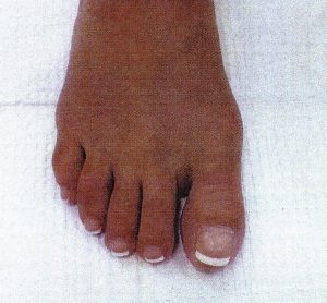 Minimally-invasive-bunion-surgery-After-4