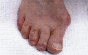 Minimally-invasive-bunion-surgery-before-3