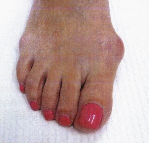 Minimally-invasive-bunion-surgery-before-4