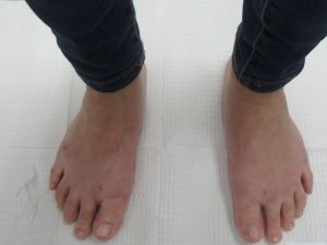 No-bunions-after-surgery.1