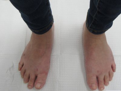 No bunions after surgery No bunions after surgery