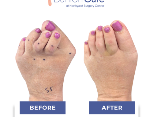 Have a Bunion That Is Causing Overlapping Toes? What to Do!