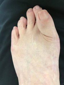 Toe Revision Before Surgery - Big Toe overlaps other toes