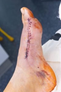 Traditional Bunion Surgery