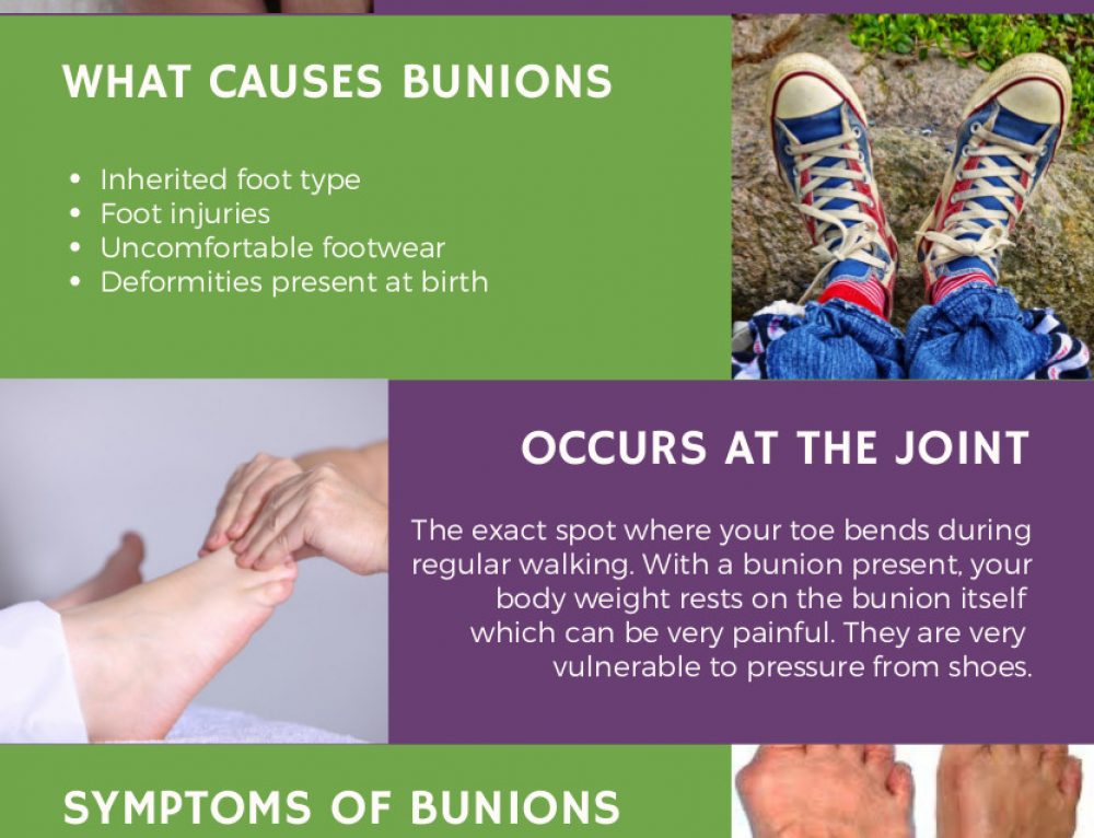 Infographic Minimally Invasive Bunion Removal Surgery The Bunion Cure
