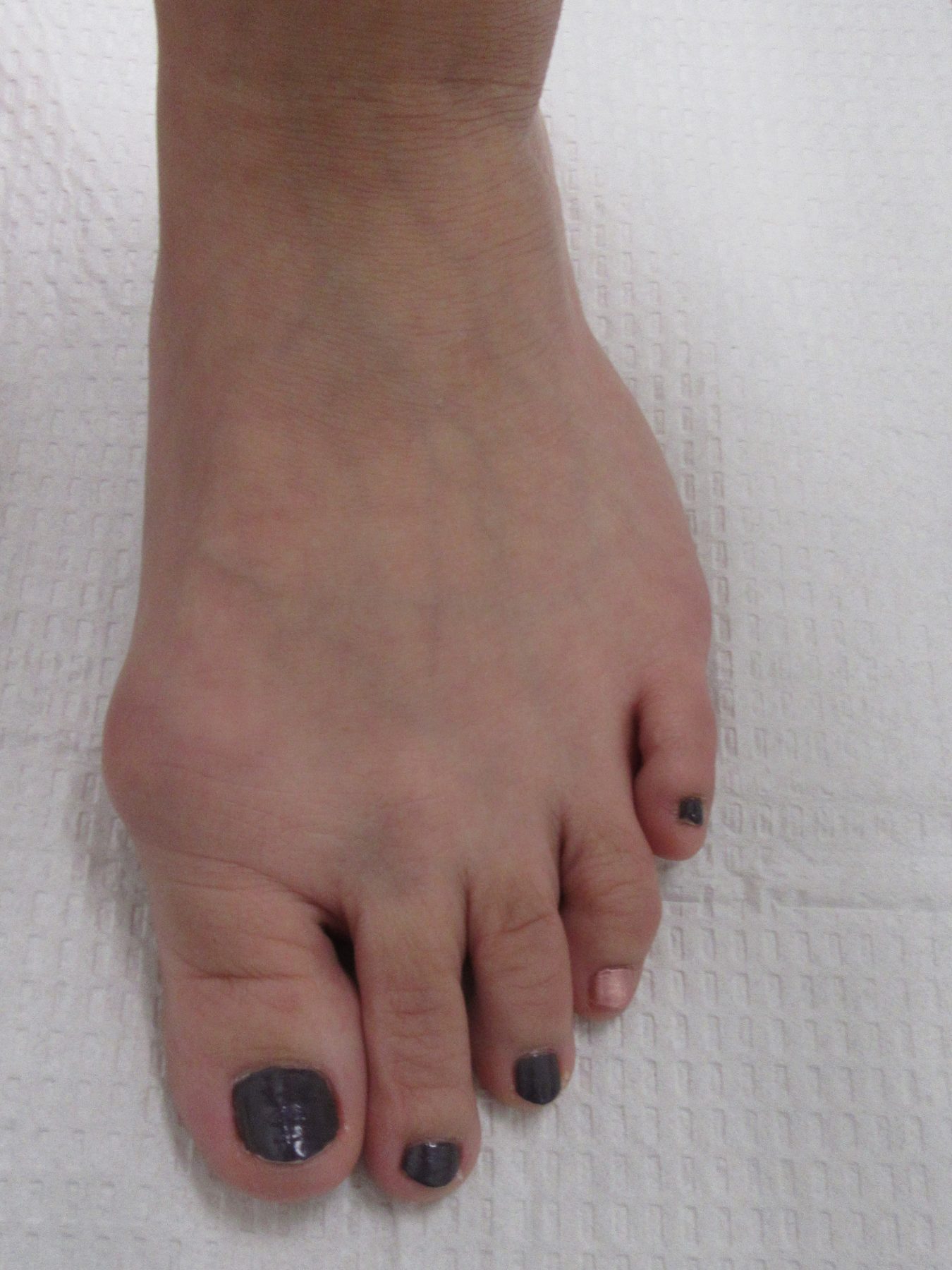 Bunion Before Surgery.2