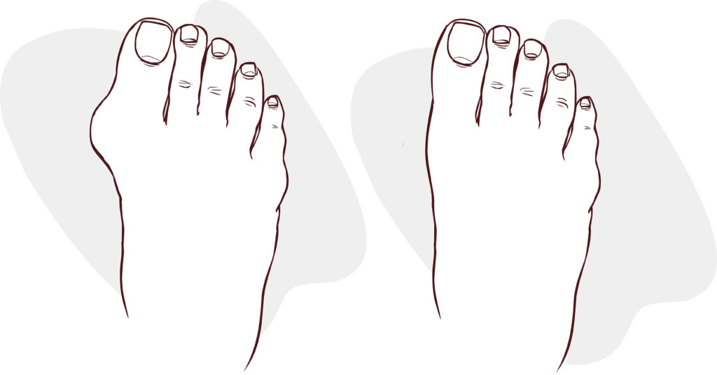 Laser Bunion Removal: Everything You Need to Know | The Bunion Cure
