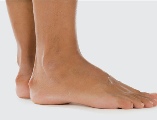 Heel Spur Relief: Home Remedies and Professional Options