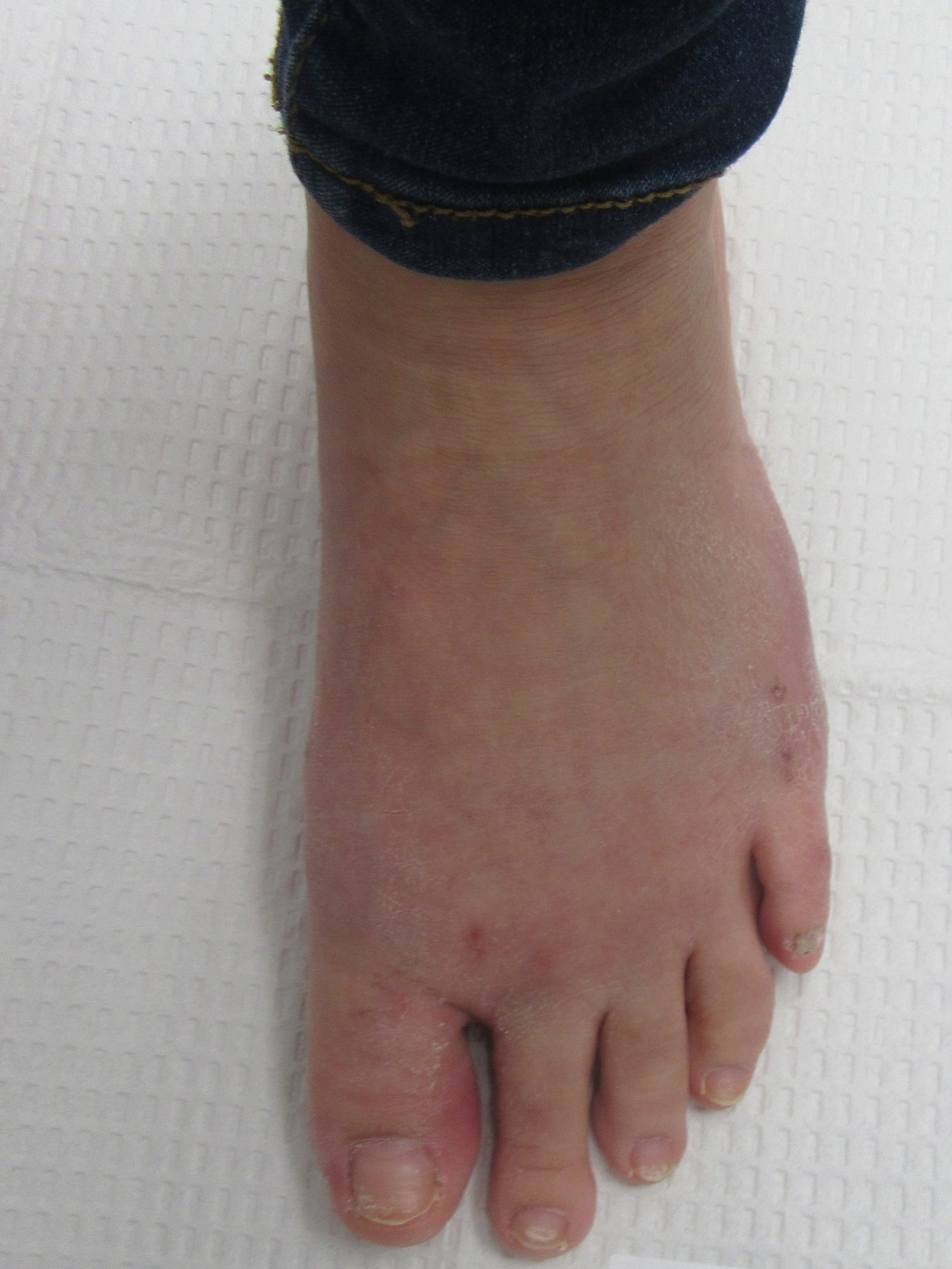 No bunion after sugery.2