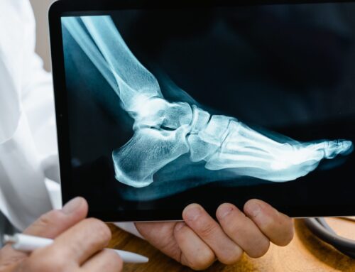 How Long Does It Take to Recover From Bunion Surgery?