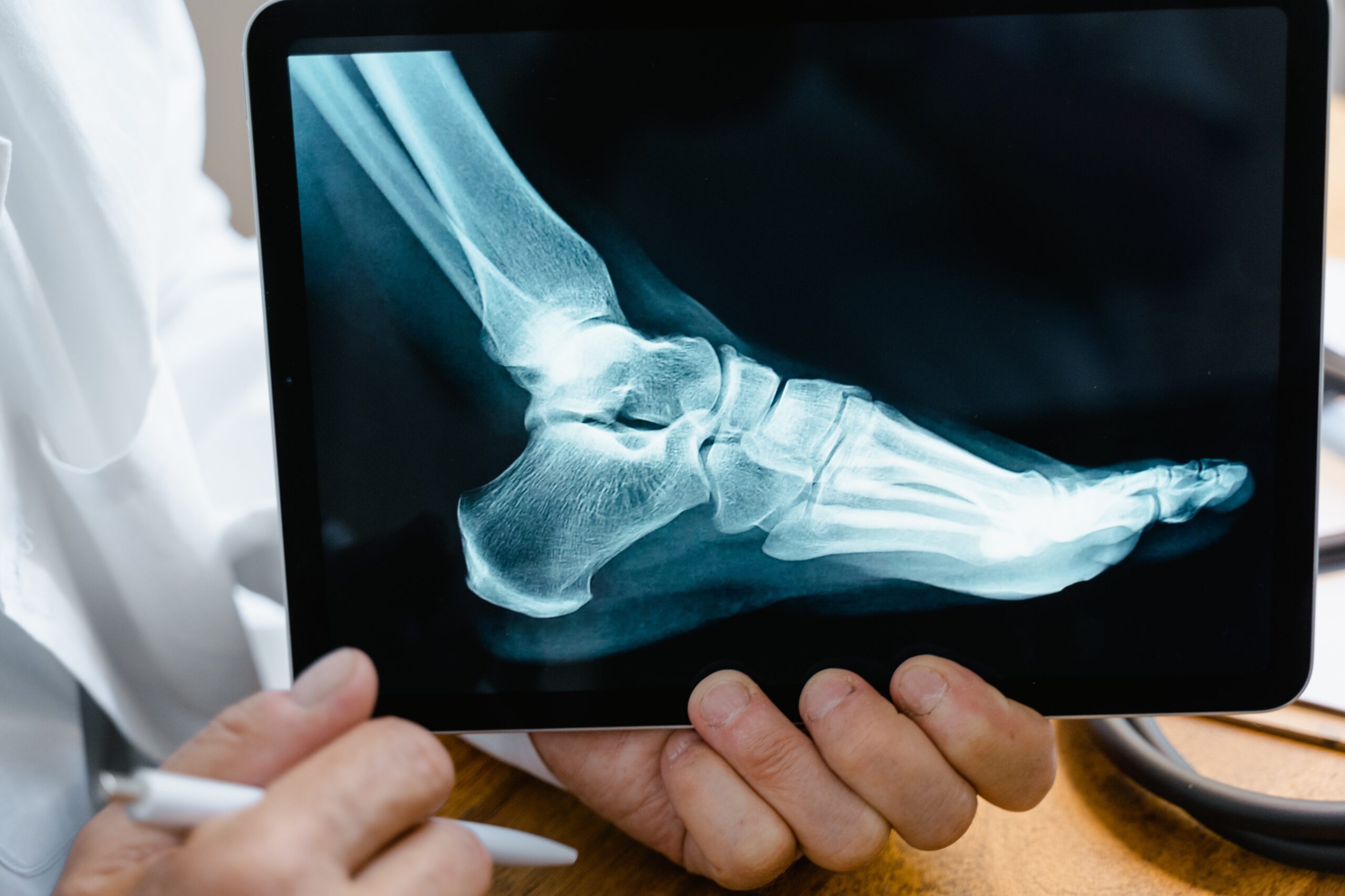 How Long Does It Take to Recover From Bunion Surgery