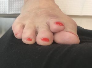 revision of a bunion and hammer toe