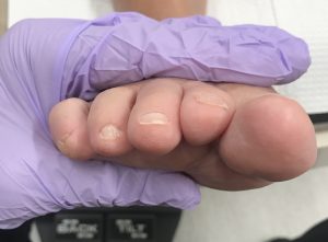 revision of a bunion and hammer toe After