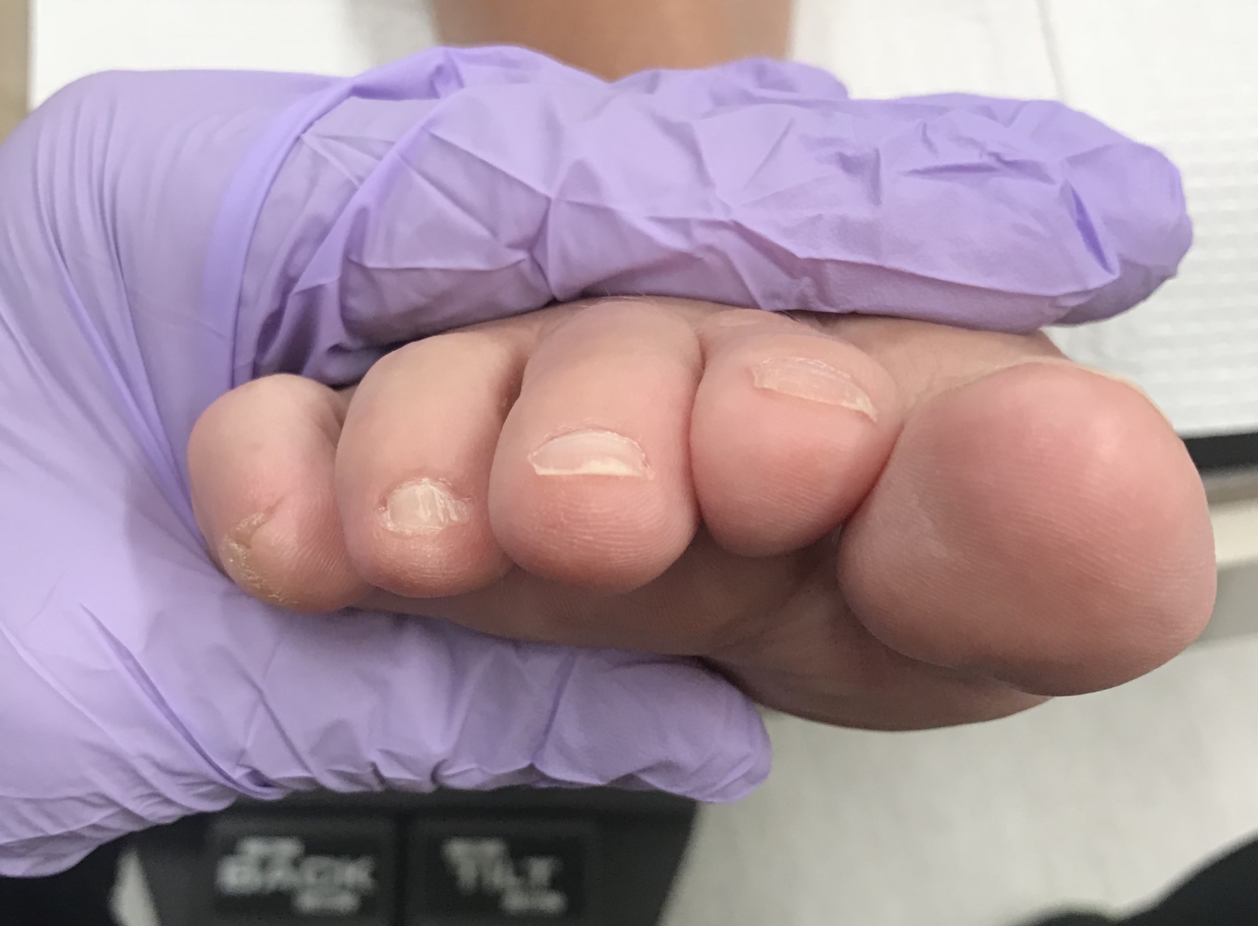 revision of a bunion and hammer toe After