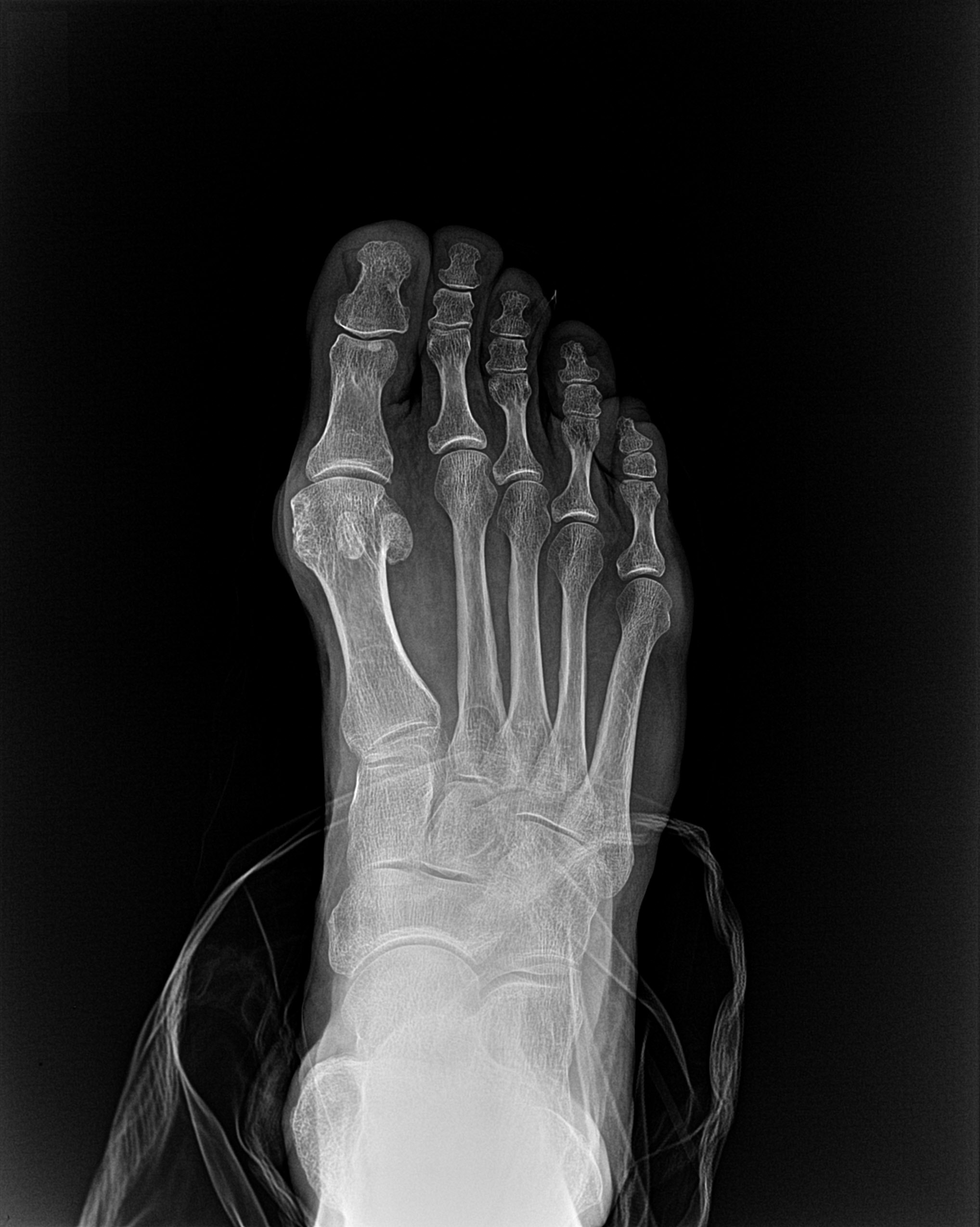 Before X-ray showing bunion alignment before minimally invasive bunion correction