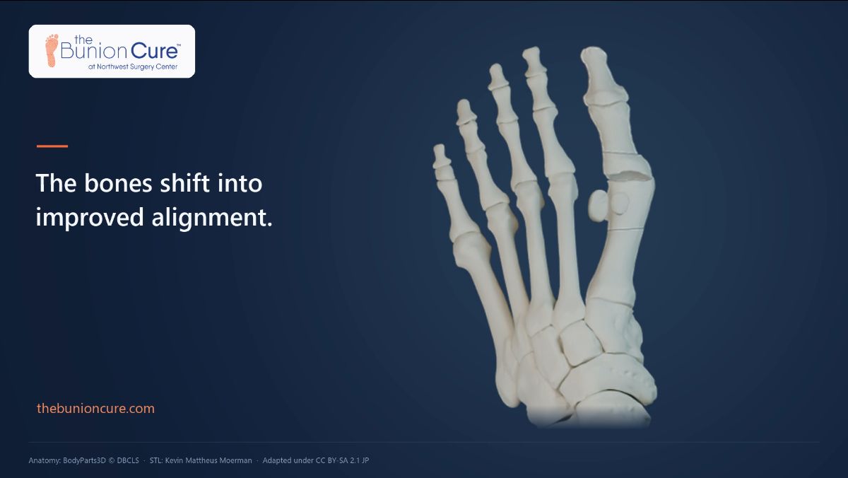 Watch the 40-second minimally invasive bunionectomy animation
